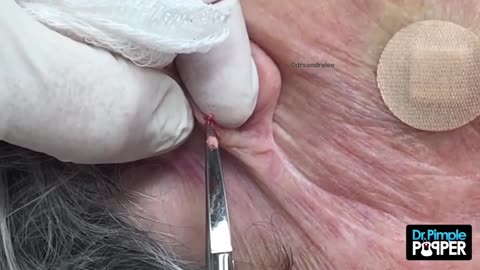 Cyst and Blackheads behind the Ear