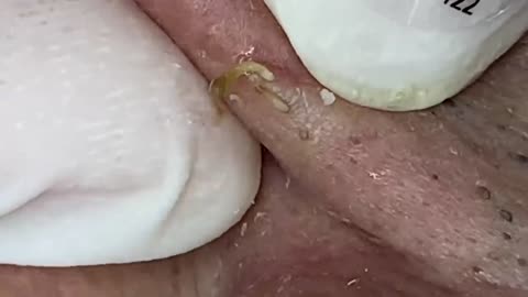 Extreme Blackhead Removal