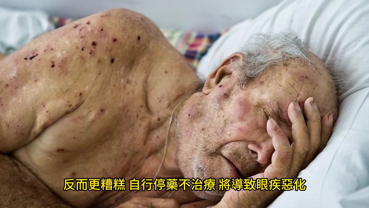 第2大致盲原因 視力小偷青光眼