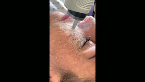 Fractional CO2 laser resurfacing