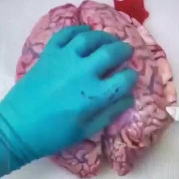 Tværsnit af Hjernen efter m_RNA Genterapi