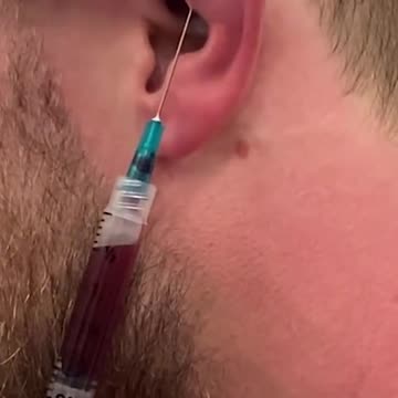 How To Drain a Cauliflower Ear