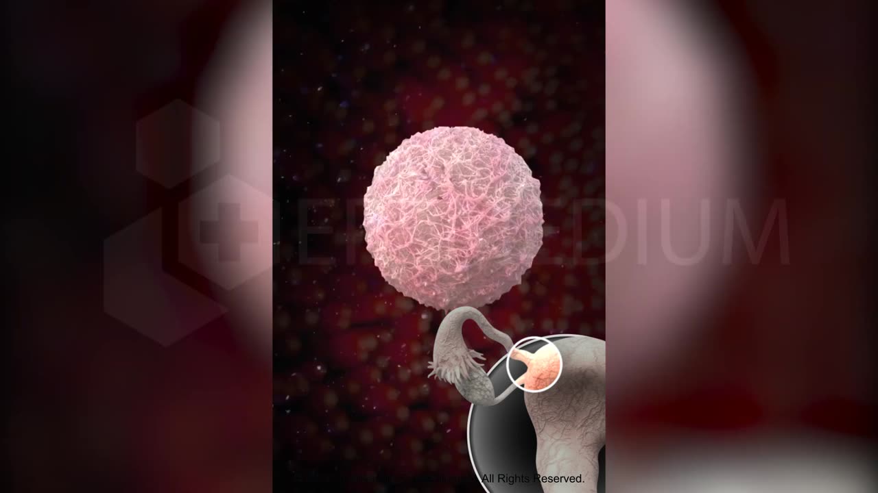 Intrauterine Insemination (IUI) for Pregnancy - Step by Step Guide - 3D Animation