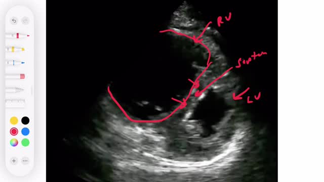 Ultrasound cardiac RV strain