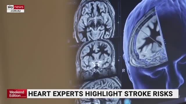 Heart Experts Say Strokes Are Rising In Younger People