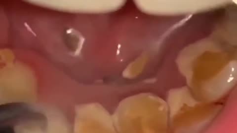 Teeth decay