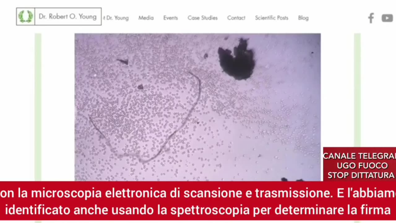 ENORMI COAGULI FIBRINICI NELLE ARTERIE DEI DECEDUTI POST VACCINO. LI PROVOCA IL GRAFENE.