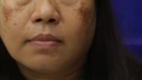 Krim Premium Kasumi Abera Jepun. Menyokong rawatan semua jenis pigmentasi kulit dengan cepat