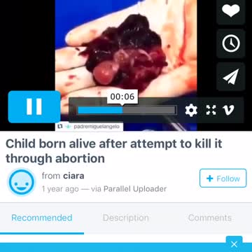 Tiny baby still alive after abortion