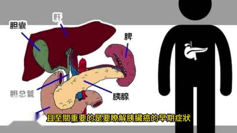 研究發現 胰臟癌兩項早期症狀