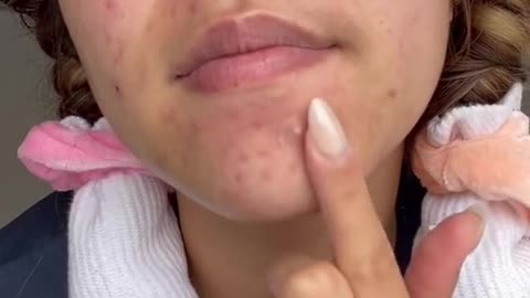 Avarelle Acne Cover Patch Hydrocolloid Acne Pimple Patches