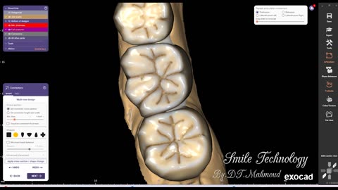 #design #naildesign #dental #dentaldesign #exocadexpert