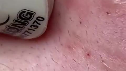 Blackheads & Milia, Big Cystic Acne Blackheads Extraction whiteheads Removal pimple Popping