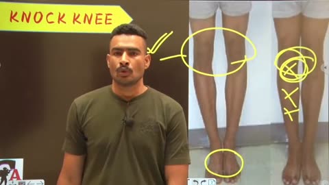 Knock Knee Fix in 1 Month | Effective Exercises