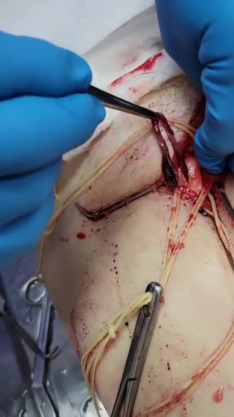 Unbelievable blood clots: video from embalmer Richard Hirschman