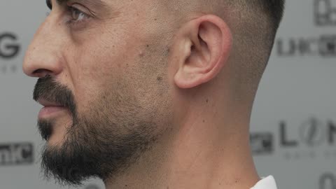 Uncomfortable with Baldness and Hair Loss? Contact Us for a Permanent Solution.