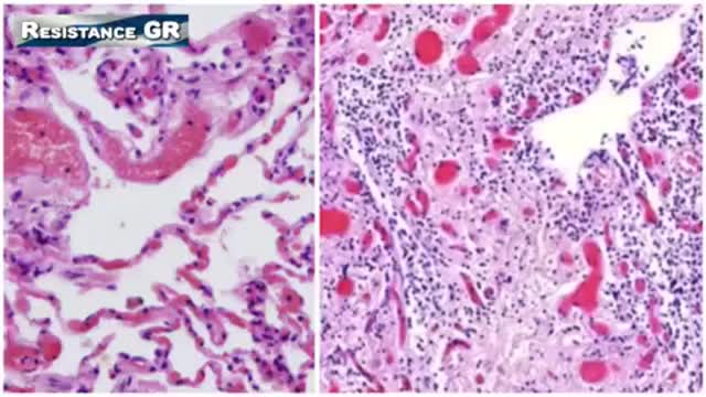 ΑΔΙΑΜΦΙΣΒΗΤΗΤΕΣ ΑΠΟΔΕΙΞΕΙΣ ΓΙΑ ΤΙΣ ΒΛΑΒΕΣ ΑΓΓΕΙΩΝ ΚΑΙ ΟΡΓΑΝΩΝ ΑΠΟ ΕΜΒΟΛΙΑ mRNA...