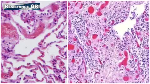 ΑΔΙΑΜΦΙΣΒΗΤΗΤΕΣ ΑΠΟΔΕΙΞΕΙΣ ΓΙΑ ΤΙΣ ΒΛΑΒΕΣ ΑΓΓΕΙΩΝ ΚΑΙ ΟΡΓΑΝΩΝ ΑΠΟ ΕΜΒΟΛΙΑ mRNA...