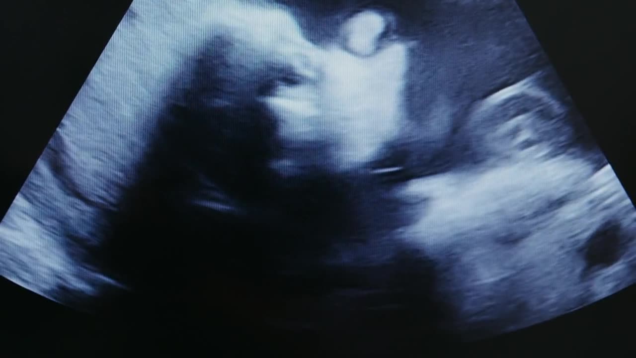 Image Of A Baby Produced By Ultrasound Procedure