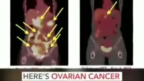 CURE FOR CANCER - DO WE REALLY THINK THIS WILL GET RELEASED? NOT UNLESS WE FORCE IT