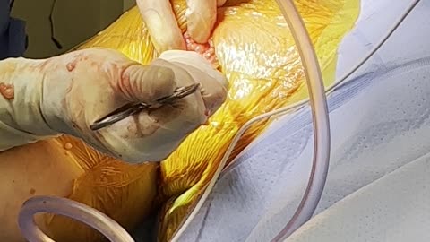 Pectoralis Major Repair Surgery
