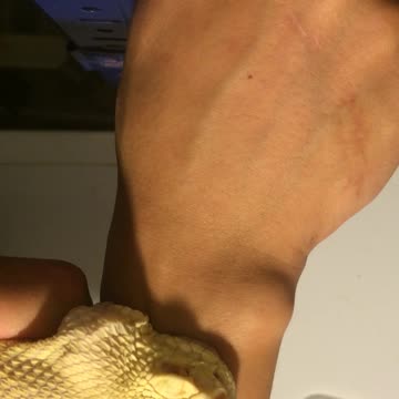 Rattlesnake Bites Hand