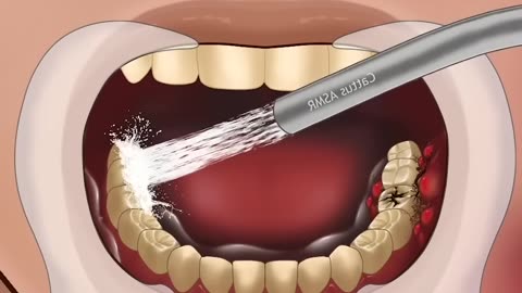 ASMR TOOTH DECAY DENTAL