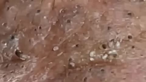 Blackhead Acne Removal