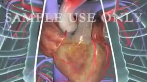 Heart Bypass Surgery