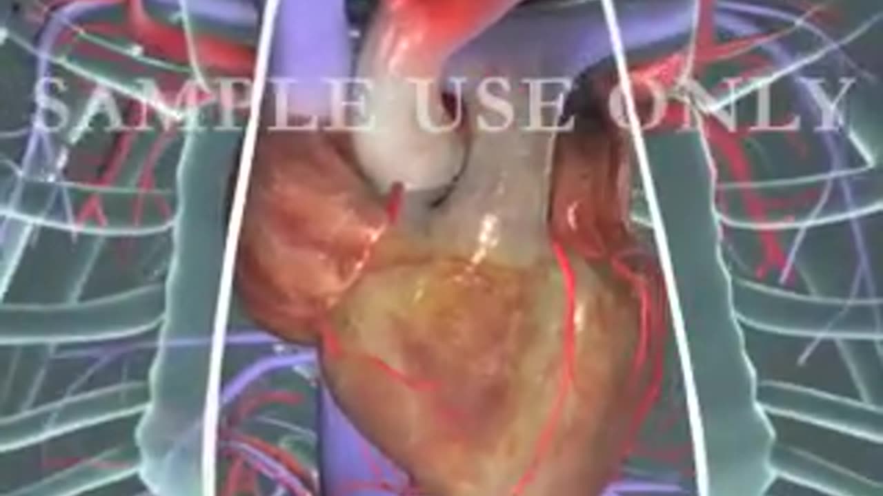 Heart Bypass Surgery