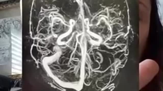 THIS IS A X-RAY OF A 👩 BRAIN AFTER THE PFIZER 💉