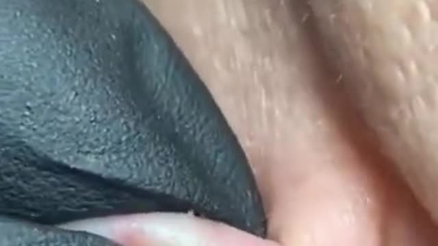 Blackhead Removal - Pimple popping - Acne Treatment - 24 #shorts