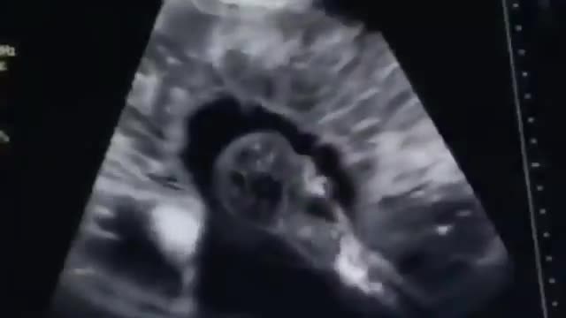 Abortion [live]