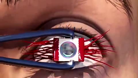 Using a tooth in eye surgery. WTF