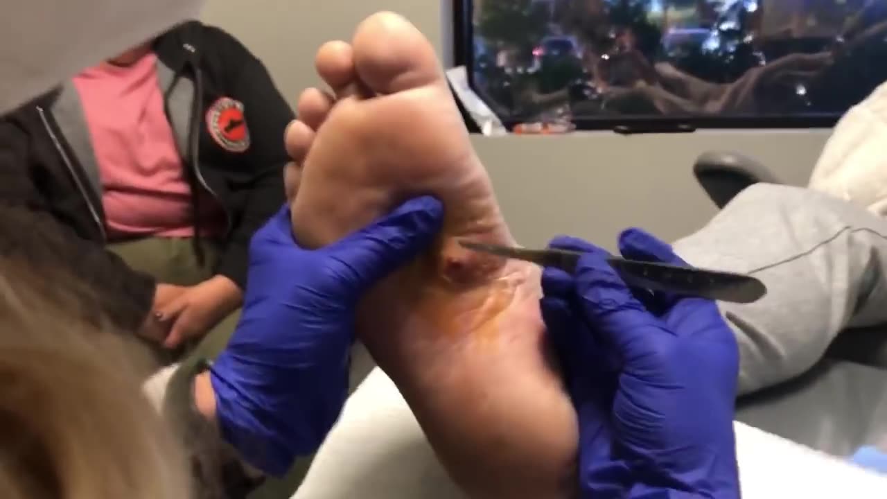 Insane inclusion cyst