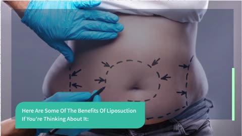 Liposuction New York