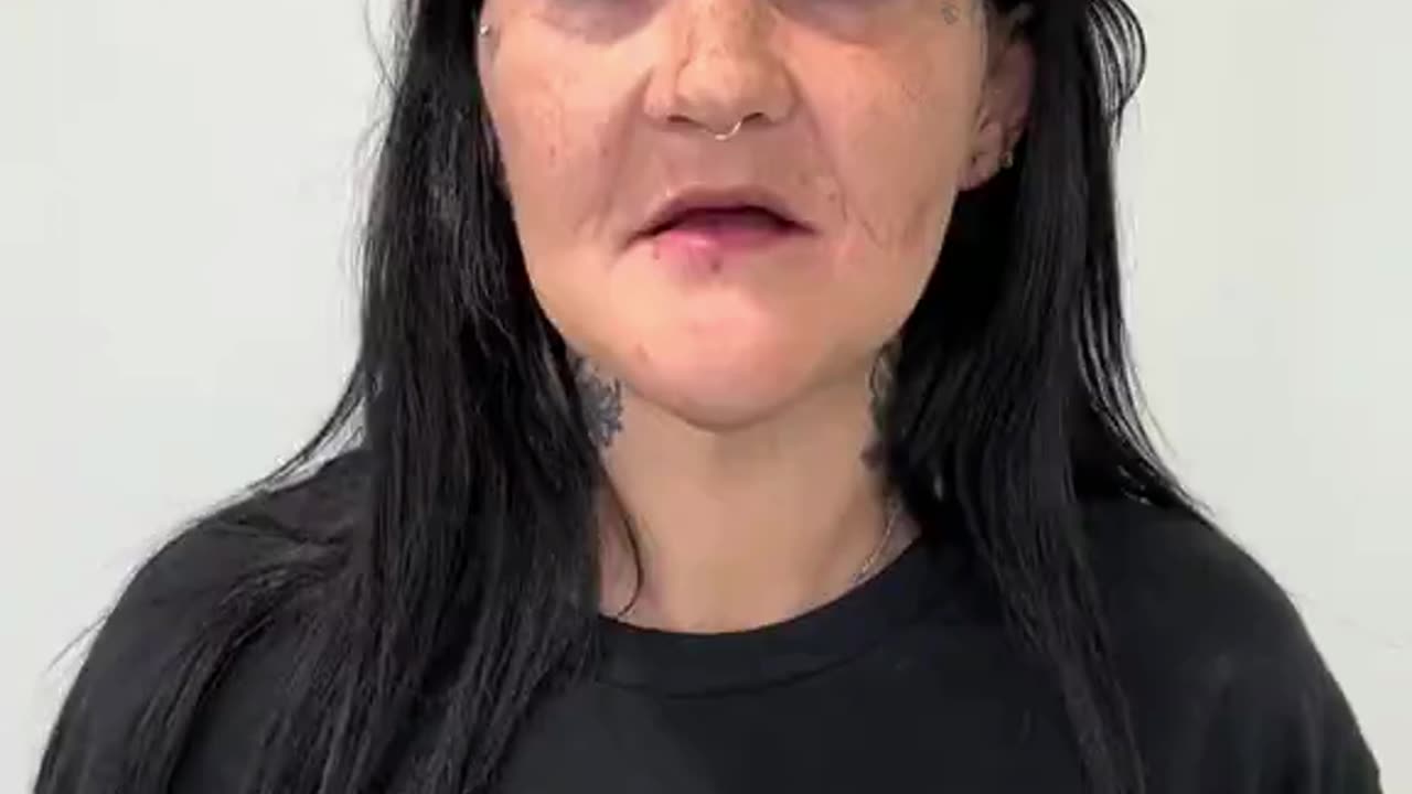 Woman Go From Looking Like a 60 Year Old to 26 Year Old With The Help of Implants