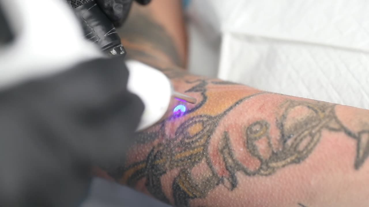 WHY DID I LASER OFF ALL MY TATTOOS? / TATTOO LASER REMOVAL