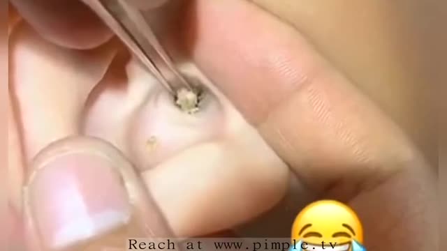 ear wax remover