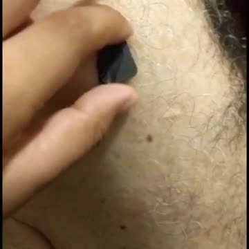 Magnet Sticking to Injected Site in India