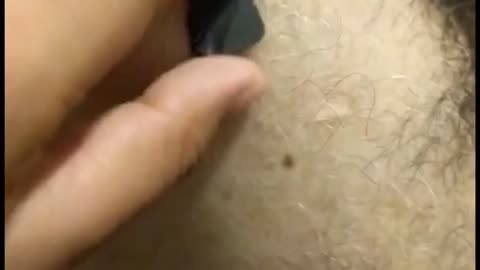 Magnet Sticking to Injected Site in India