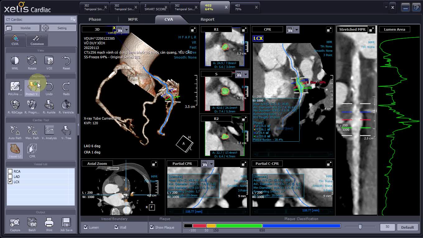 CT Cardiac with Xelis (INFINITT PACS)