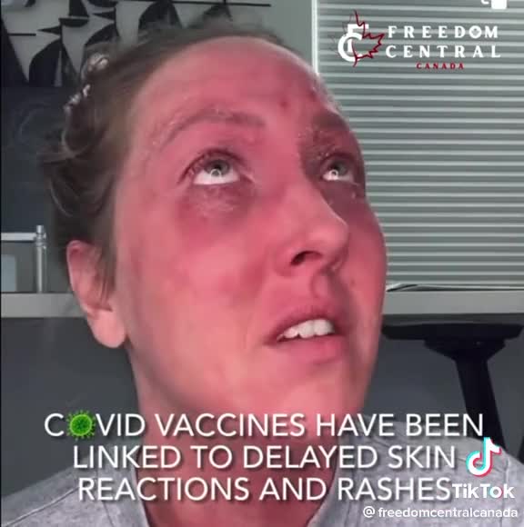 ANOTHER 'JAB' INJURY 😪 I THINK THEY ARE STARTING TO FIGGURE IT OUT