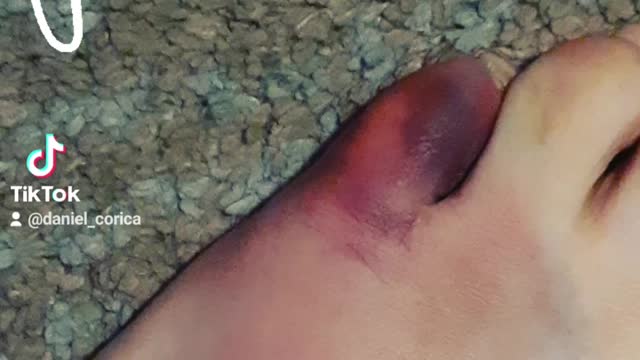 Bashed my toe while on blood thinners.