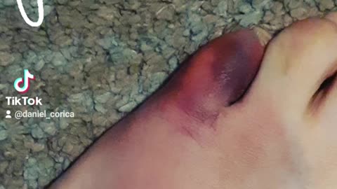 Bashed my toe while on blood thinners.