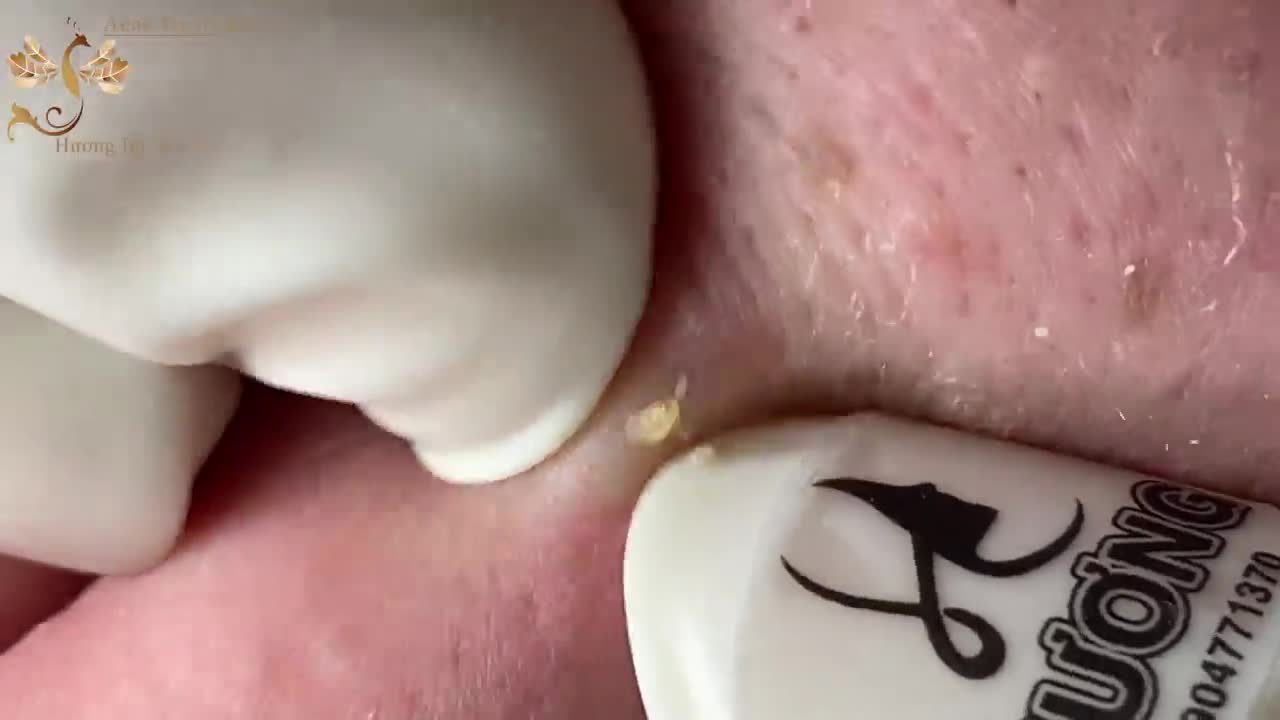 #132 | Acne Treatment Huong beauty