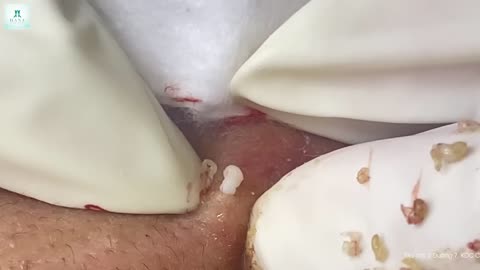Big Cystic Acne Blackheads Extraction Blackheads & Milia, Whiteheads Removal Pimple Popping