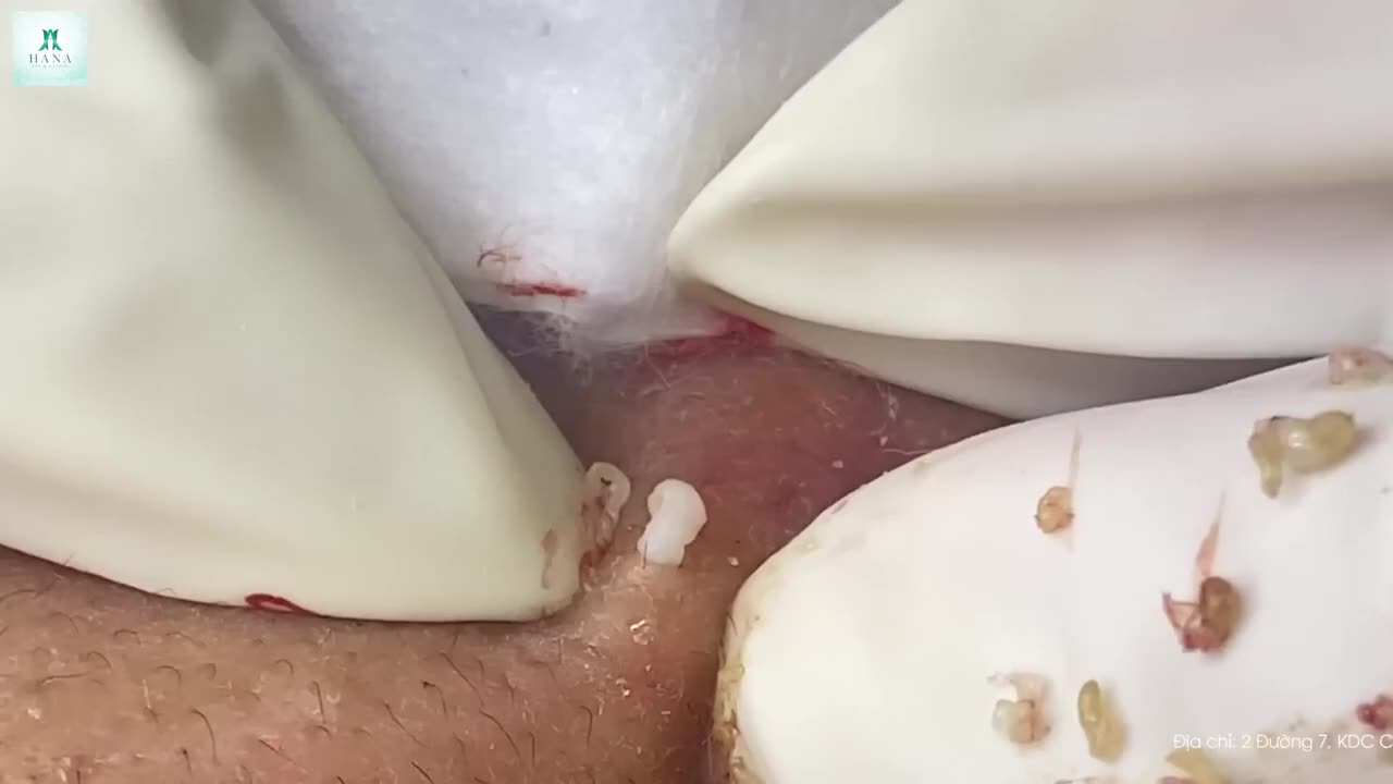 Big Cystic Acne Blackheads Extraction Blackheads & Milia, Whiteheads Removal Pimple Popping