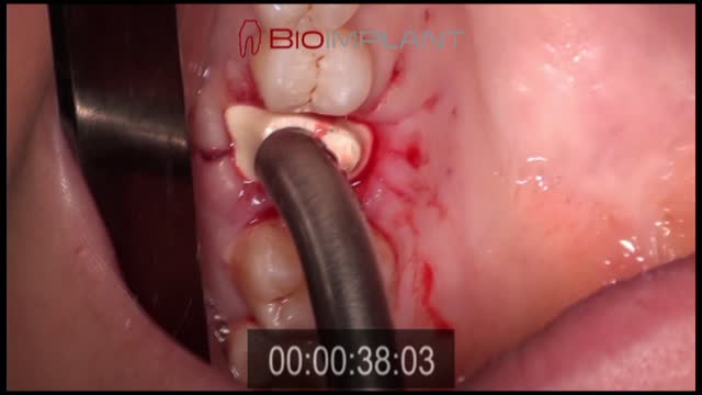 THIS IS A REVOLUTIONARY IMMEDIATE DENTAL IMPLANT SOLUTION PLACED COMPLETELY NON-SURGICAL