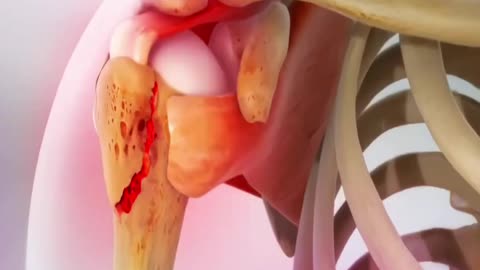 Types of Bone Fracture 3D Animation